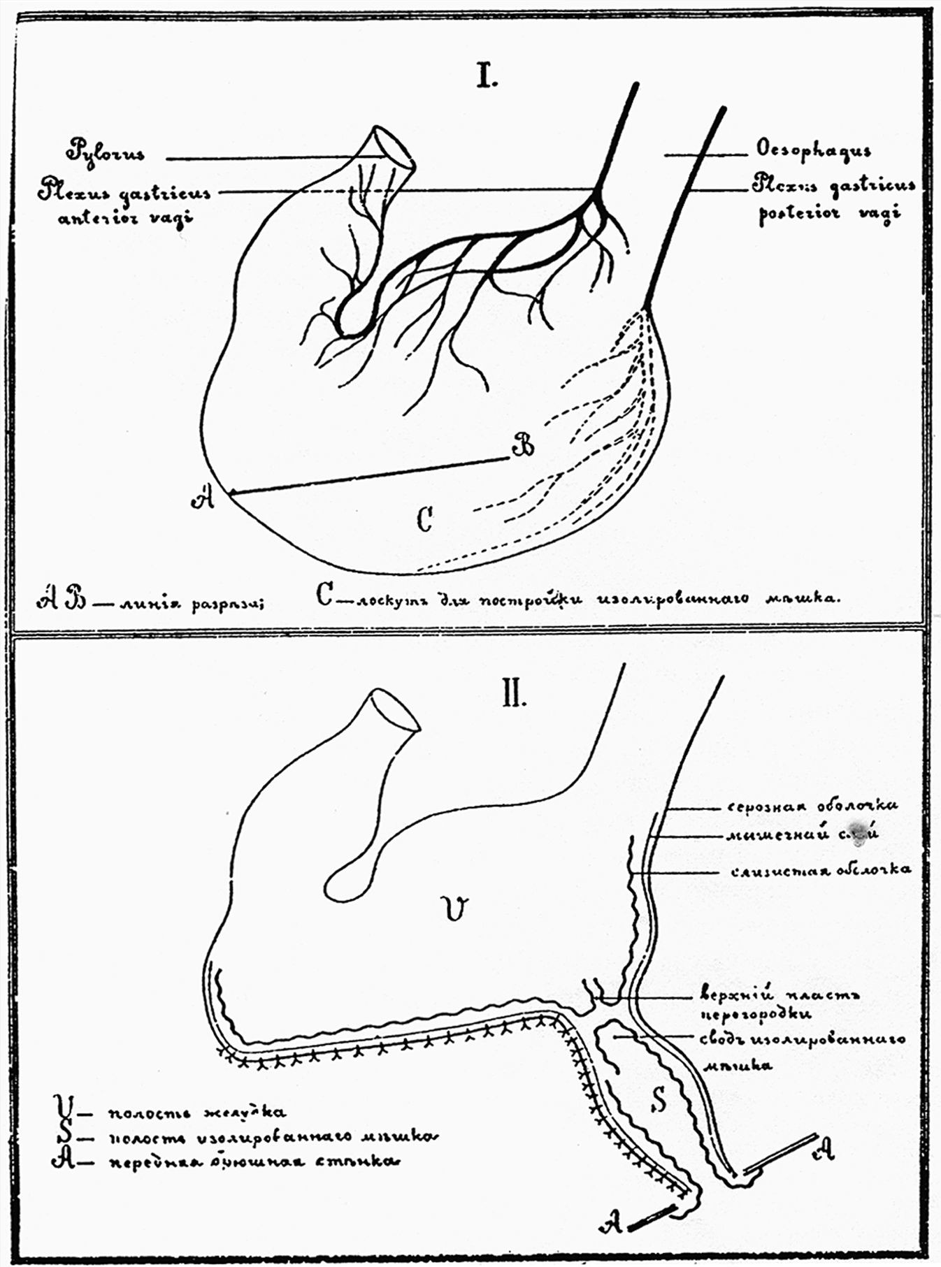 Операция изолированного желудочка по Павлову